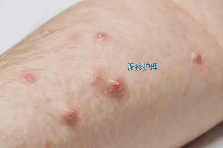 青少年手臂出现湿疹可以彻底自愈吗(图4)