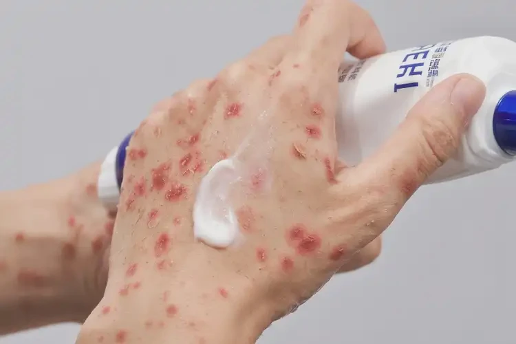 青年人手上長(zhǎng)濕疹可不可以徹底自愈(圖3)