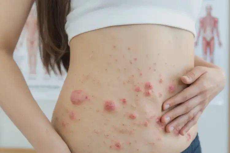 女生肚子上經(jīng)常起濕疹可以徹底自愈嗎(圖4)