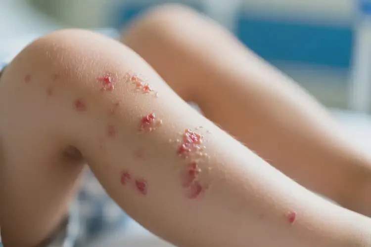 小孩小腿偶爾長(zhǎng)濕疹可不可以根治(圖4)