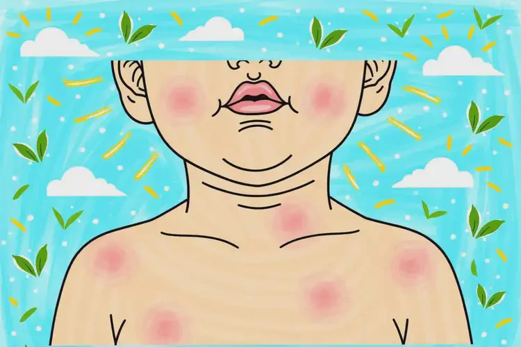 寶寶脖子上容易起濕疹能靠自己自愈嗎(圖4)