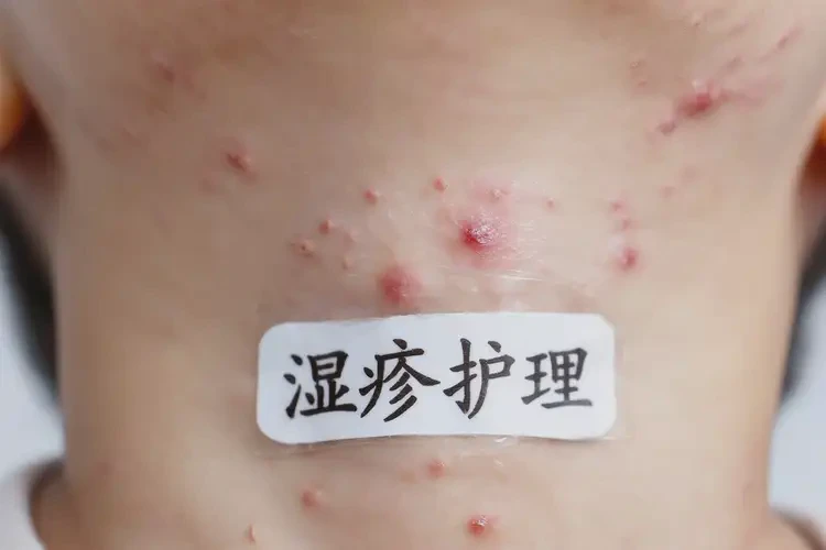少兒脖子有濕疹可不可以根治(圖4)