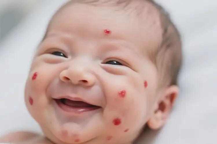 新生兒臉上出濕疹不管它會自己好嗎(圖1)