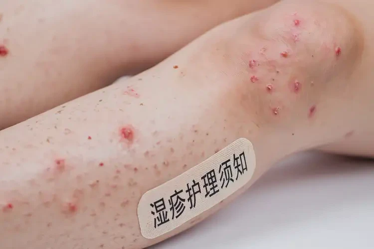 少兒小腿偶爾長(zhǎng)濕疹可不可以根治(圖3)