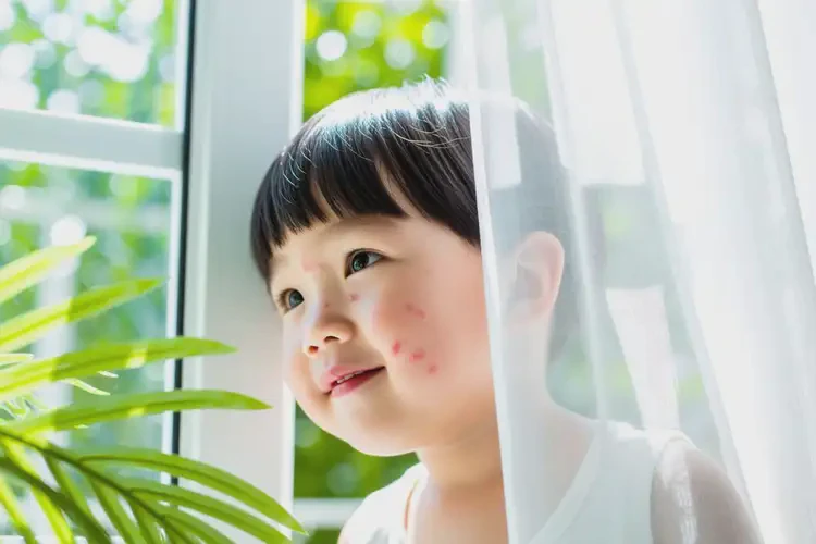 幼兒臉上偶爾長濕疹不管它會自己好嗎(圖2)