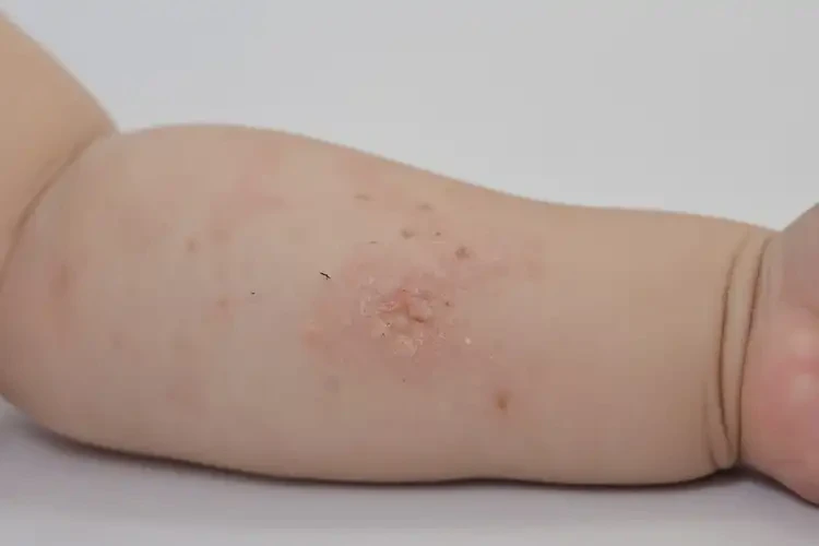 少兒手臂長濕疹不管它會自己好嗎(圖4)