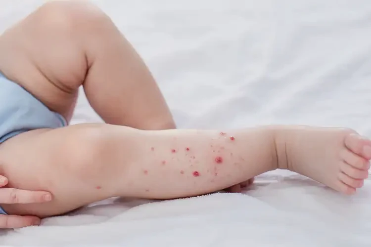 宝宝小腿上有湿疹可不可以根治(图3)