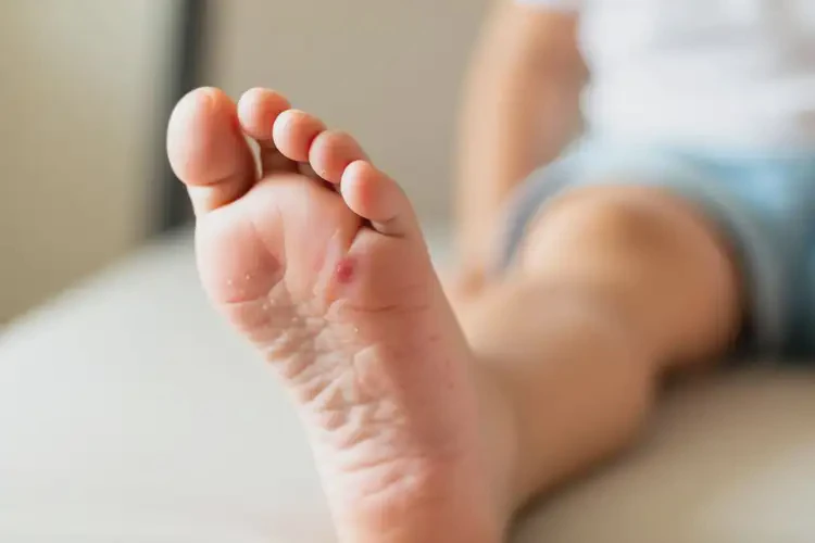 少兒腳上出現(xiàn)濕疹可不可以根治(圖3)