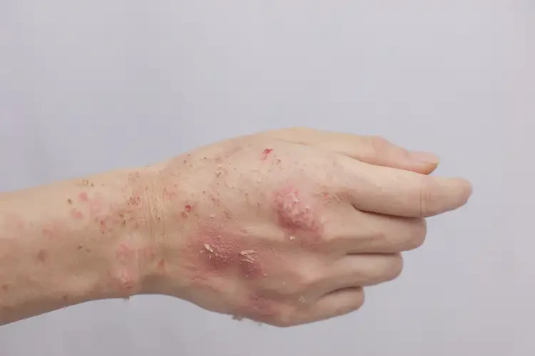 產(chǎn)婦手上偶爾長濕疹不管它會自己自愈嗎(圖2)