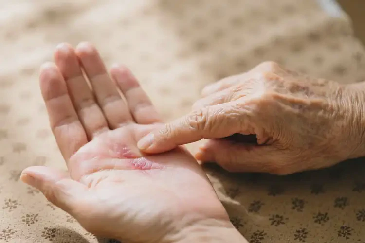 高齡老人手上經(jīng)常起濕疹可不可以徹底自愈(圖2)