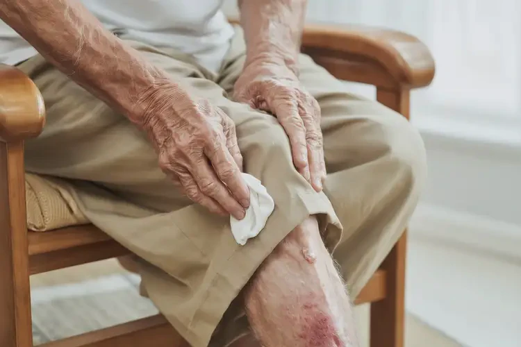 高齡老人大腿偶爾長(zhǎng)濕疹可不可以徹底自愈(圖3)