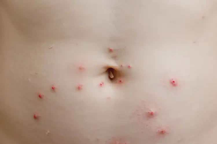 小孩肚子出現(xiàn)濕疹可不可以徹底自愈(圖4)