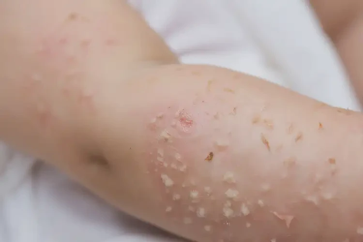 幼兒手臂上起濕疹不管它會自己自愈嗎(圖4)