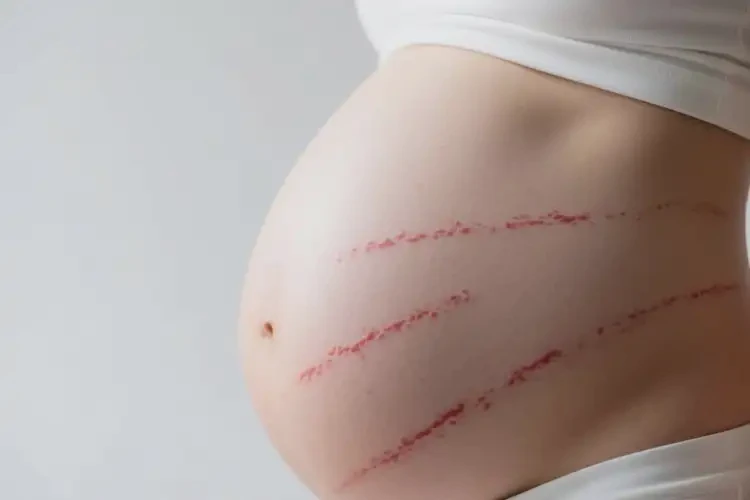 孕婦肚子容易長(zhǎng)濕疹不管它會(huì)自己好嗎(圖1)