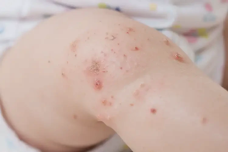 婴幼儿小腿偶尔长湿疹可不可以彻底自愈(图4)