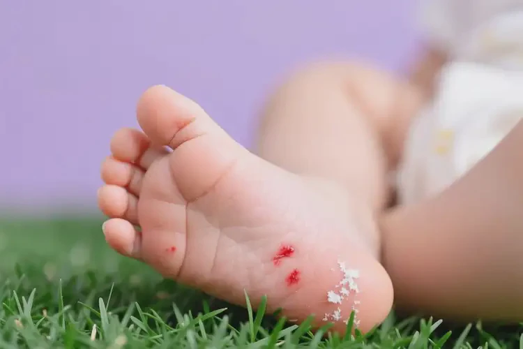 嬰幼兒腳上偶爾長濕疹能徹底自愈嗎(圖2)