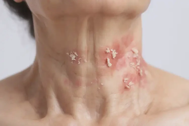 女人脖子上長(zhǎng)濕疹可不可以徹底自愈(圖4)