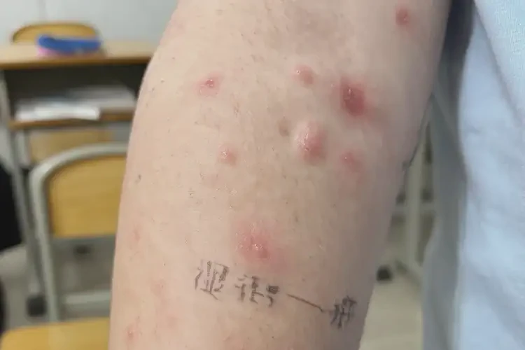 小學(xué)生手上容易起濕疹可以徹底自愈嗎(圖4)