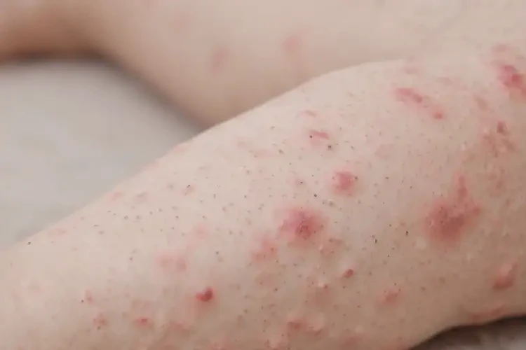 兒童四肢出現(xiàn)濕疹可不可以根治(圖4)