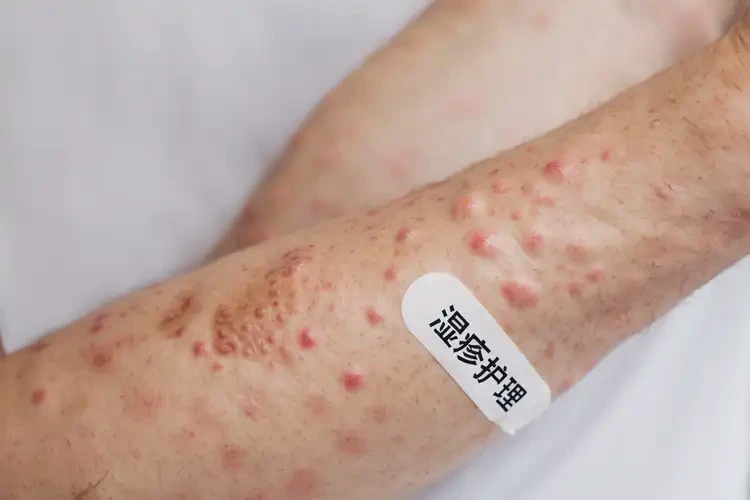 男生手臂上經(jīng)常長濕疹能徹底自愈嗎(圖4)