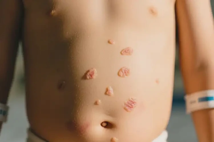 小孩肚子上起濕疹可不可以根治(圖3)