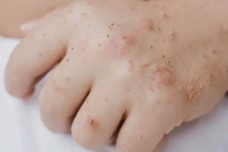 孩子手上有濕疹可不可以徹底自愈(圖4)