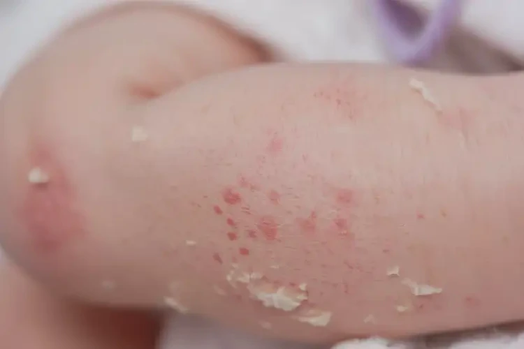 新生兒小腿經(jīng)常起濕疹可不可以徹底自愈(圖4)