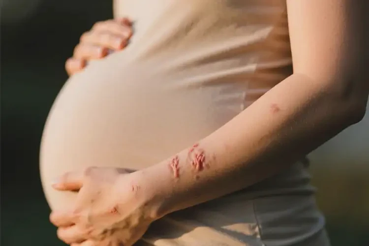孕婦身上經(jīng)常長濕疹能夠徹底治愈嗎(圖1)
