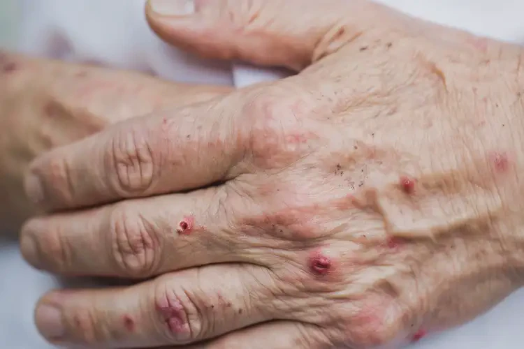 高齡老人手上起濕疹能不能根治(圖4)