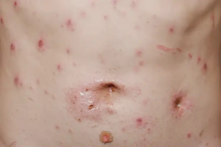 中學(xué)生肚子起濕疹能夠徹底治愈嗎(圖4)