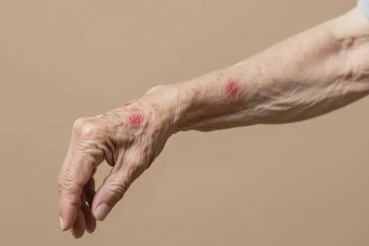 高齡老人手臂上偶爾起濕疹能不能根治(圖1)