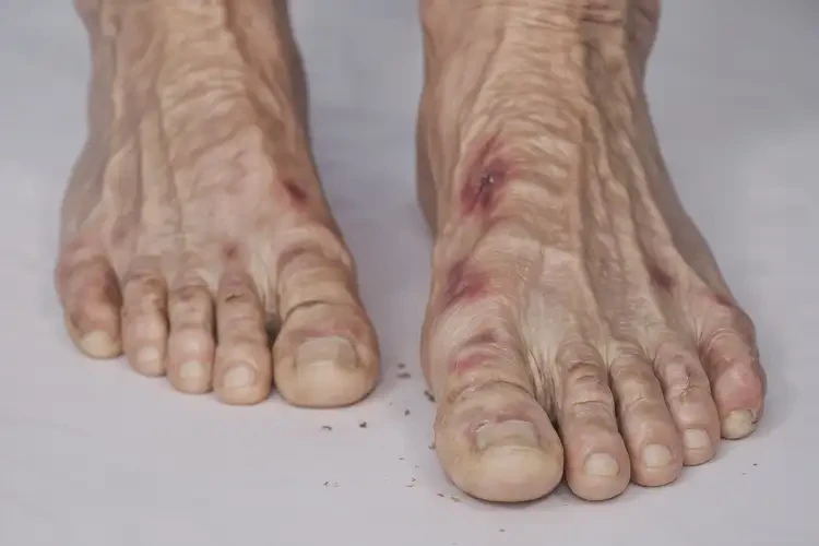 高齡老人腳上出濕疹可不可以徹底自愈(圖4)