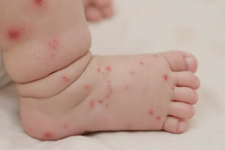 寶寶小腿出濕疹可不可以根治(圖3)