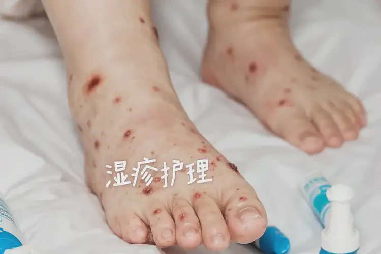 兒童腳上經(jīng)常起濕疹能靠自己自愈嗎(圖4)