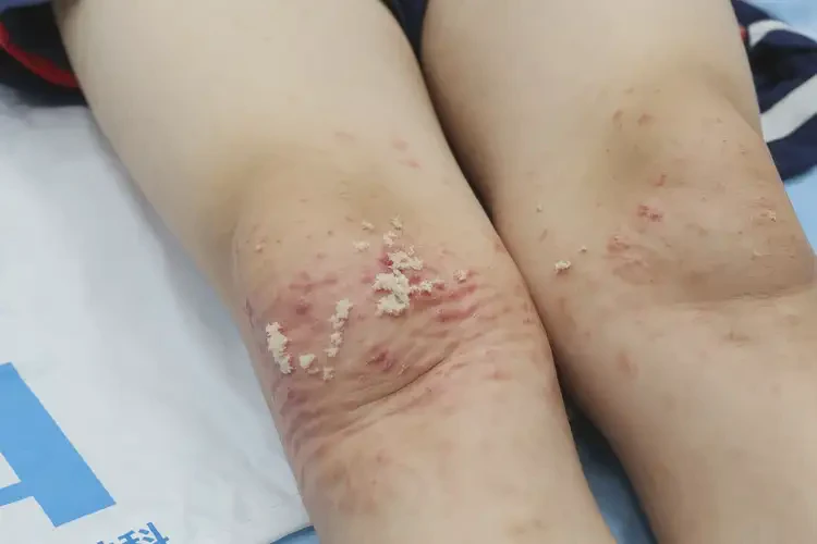 小學生小腿上出現(xiàn)濕疹能不能徹底自愈(圖3)