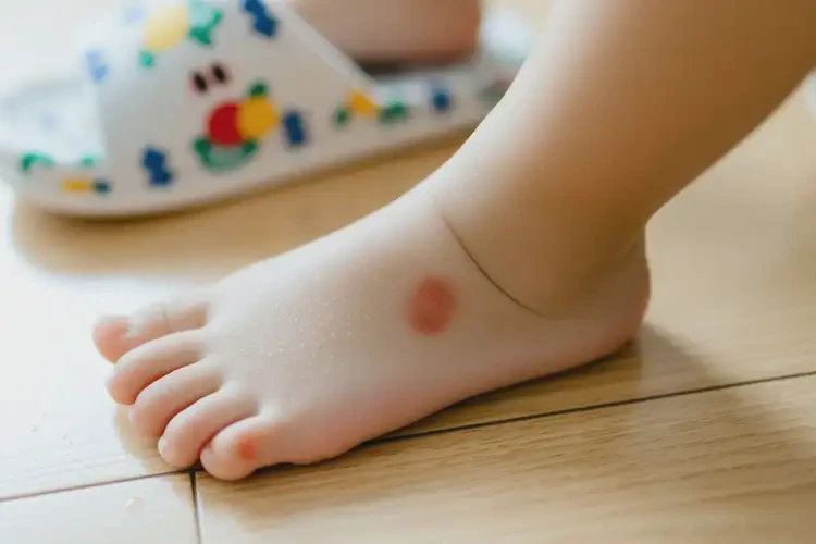 小孩腳上出現(xiàn)濕疹可不可以根治(圖2)