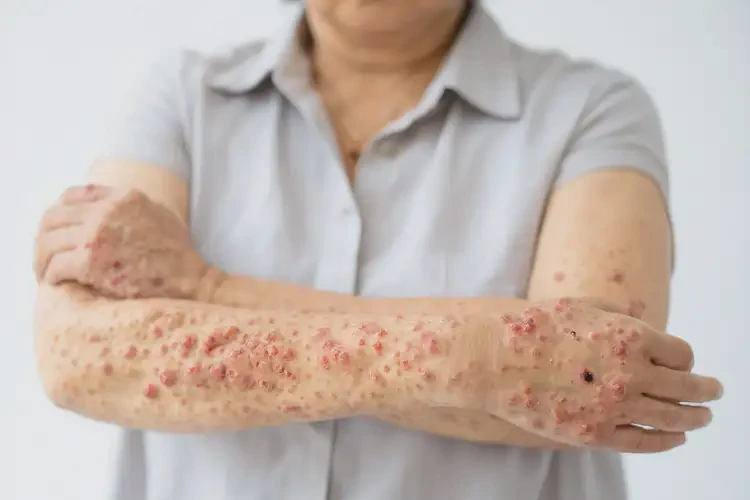 男生小腿偶爾長(zhǎng)濕疹不管它會(huì)自己痊愈嗎(圖4)