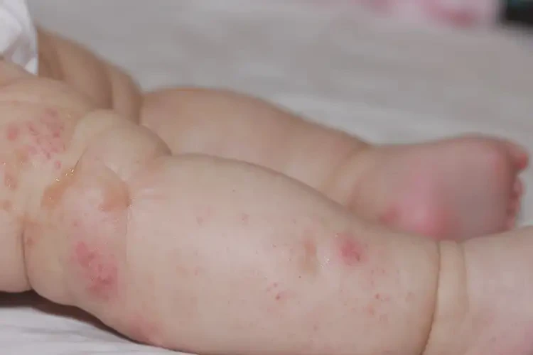 寶寶小腿容易長(zhǎng)濕疹不管它會(huì)自己自愈嗎(圖3)