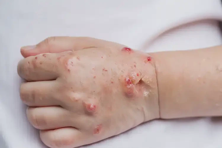 孩子全身偶爾長(zhǎng)濕疹不管它會(huì)自己自愈嗎(圖2)