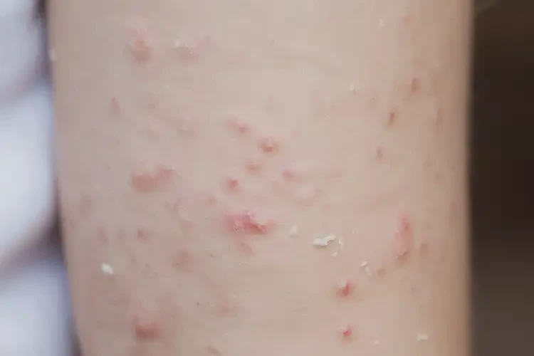 孩子身上偶爾起濕疹不管它會自己痊愈嗎(圖4)