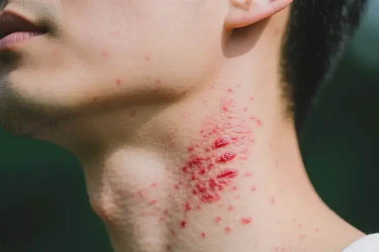 男人脖子長濕疹能不能根治(圖1)