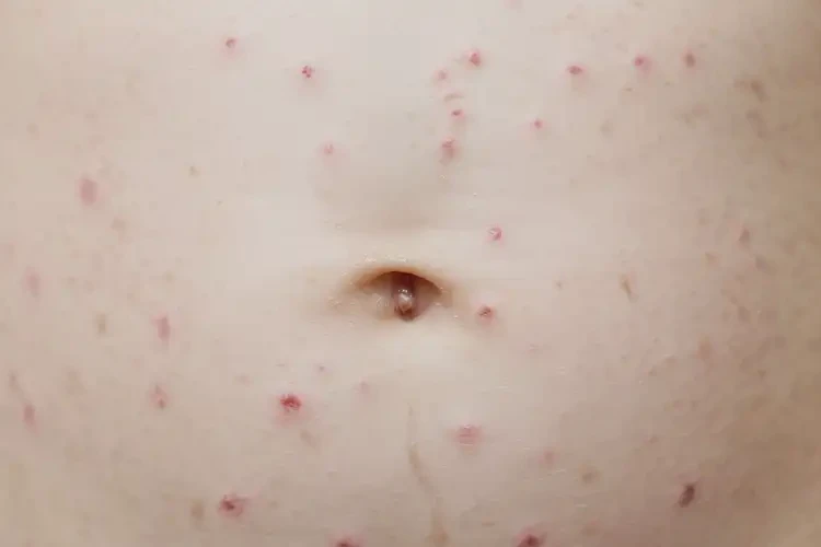 嬰兒肚子容易起濕疹可不可以根治(圖4)