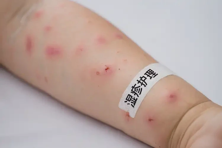 幼兒手臂經(jīng)常起濕疹能夠徹底治愈嗎(圖4)