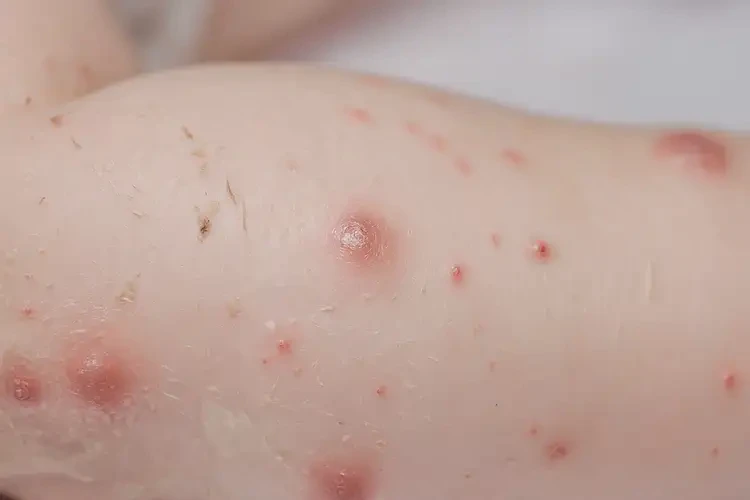 幼兒全身有濕疹不管它會自己好嗎(圖4)