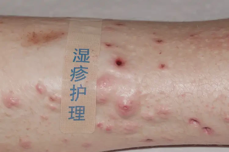 老年人小腿上偶尔长湿疹能彻底自愈吗(图4)