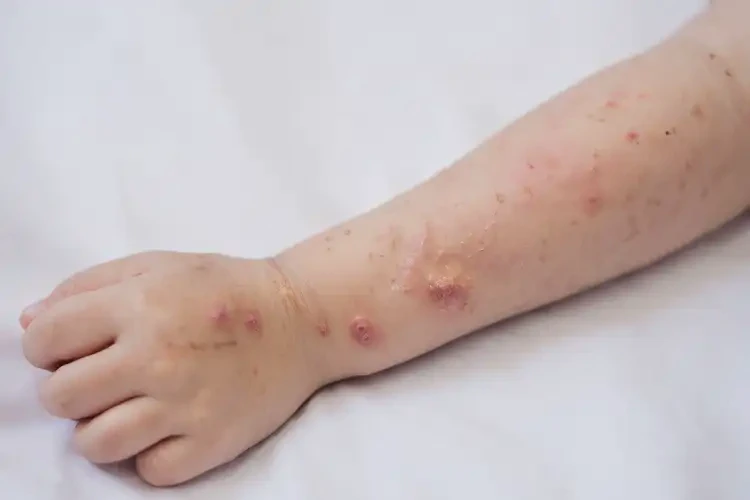 孩子全身偶爾長(zhǎng)濕疹不管它會(huì)自己自愈嗎(圖3)