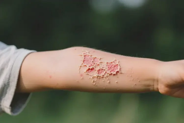 孩子手臂有濕疹可不可以根治(圖2)