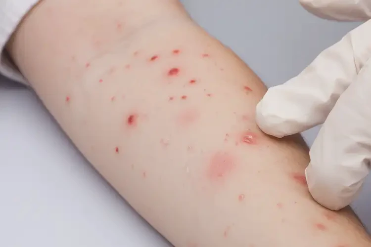 小儿全身偶尔起湿疹不管它会自己好吗(图4)