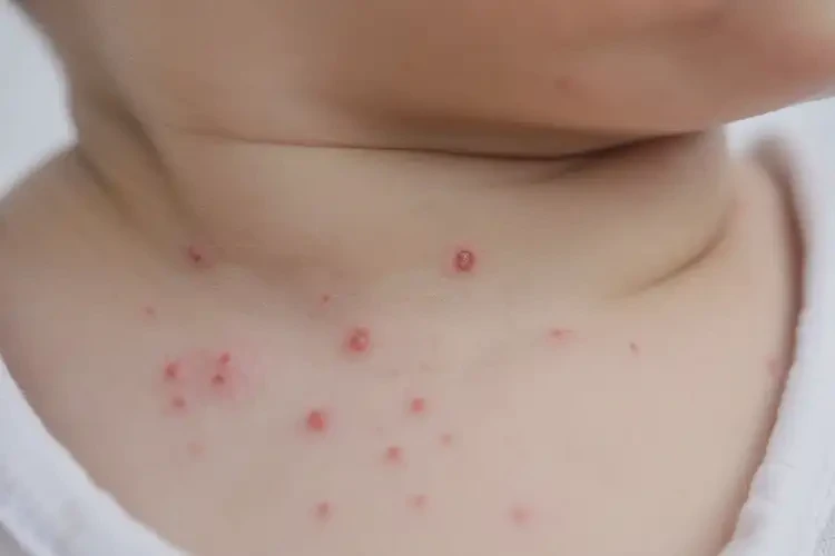 婴幼儿脖子上长湿疹可不可以根治(图4)