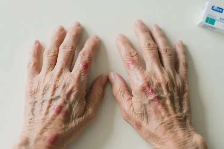 老年人手上起濕疹不管它會(huì)自己好嗎(圖4)